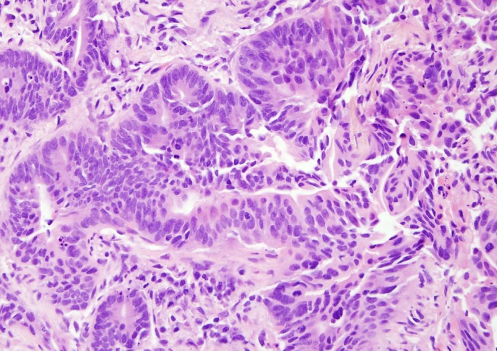 Non-small cell lung carcinoma under high magnification