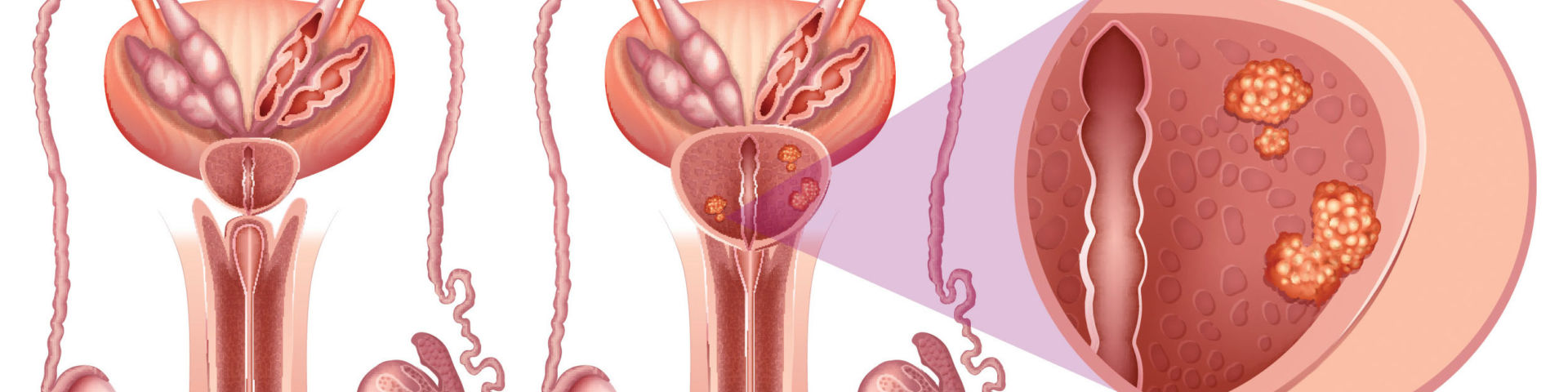 Prostate diagram banner